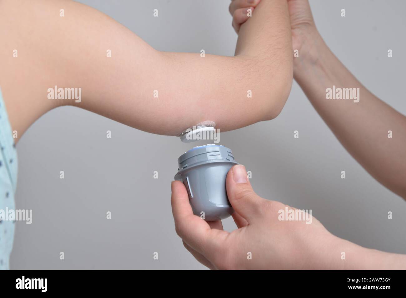 Posizionamento del sensore per diabetici sul muscolo destro. Concetti medici, sanitari, di gestione del diabete o tecnologici. Foto Stock