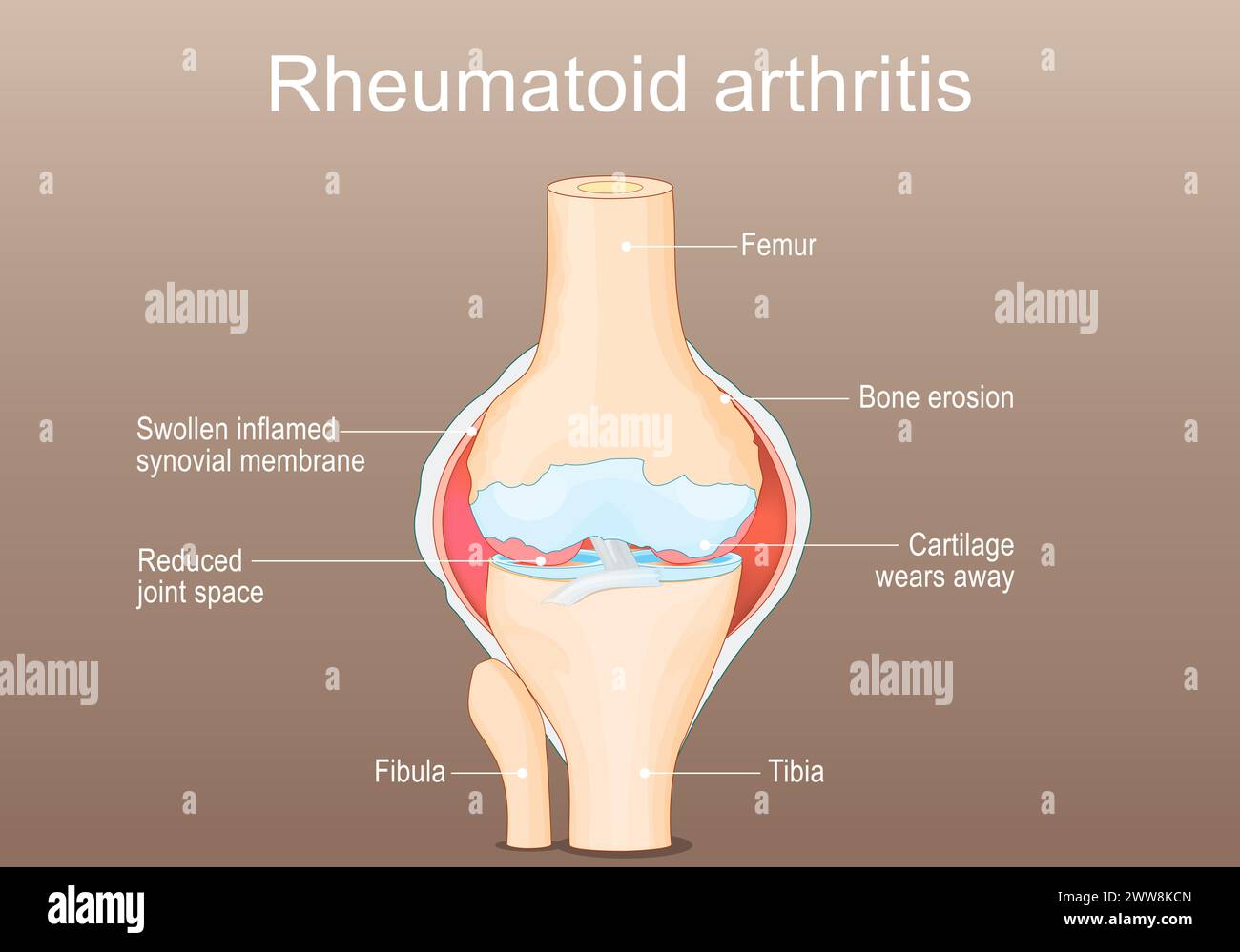 Artrite reumatoide RA. Tipo infiammatorio di artrite che colpisce il ginocchio. Malattia autoimmune. Il sistema immunitario attacca erroneamente l'articolazione sana Illustrazione Vettoriale