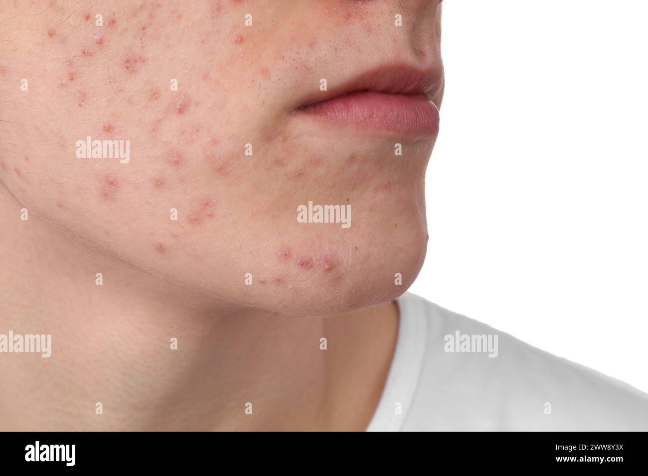 Giovane con problemi di acne isolato su bianco, primo piano Foto Stock