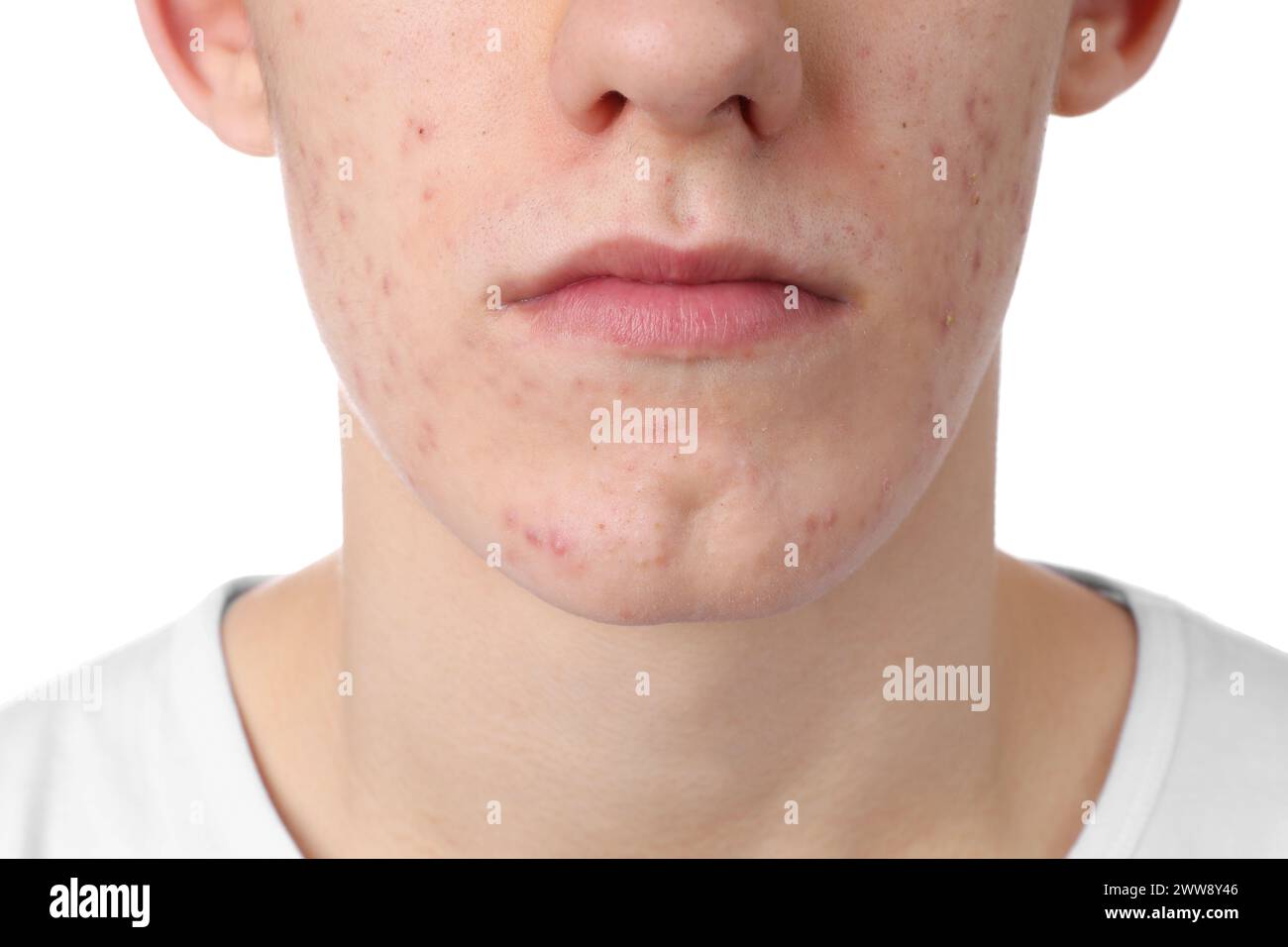 Giovane con problemi di acne isolato su bianco, primo piano Foto Stock