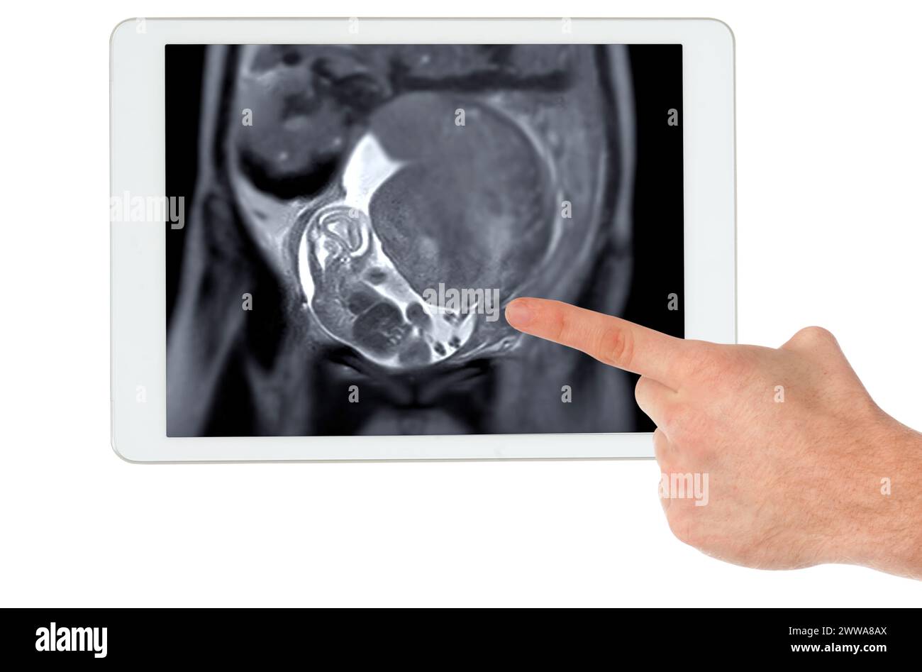 La risonanza magnetica durante la gravidanza assicura una valutazione non invasiva della salute del feto su tablet, la sicurezza materna, l'assistenza ostetrica e la precisione diagnostica, offrendo de Foto Stock