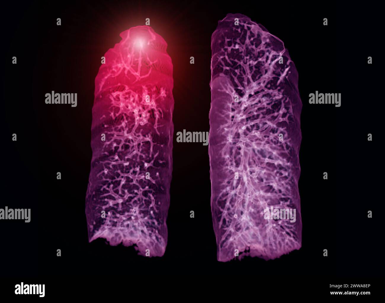 Una scansione TC toracica 3D che visualizza una lesione sul lobo superiore destro offre una visualizzazione dettagliata, facilitando l'identificazione precisa e i planni di trattamento Foto Stock
