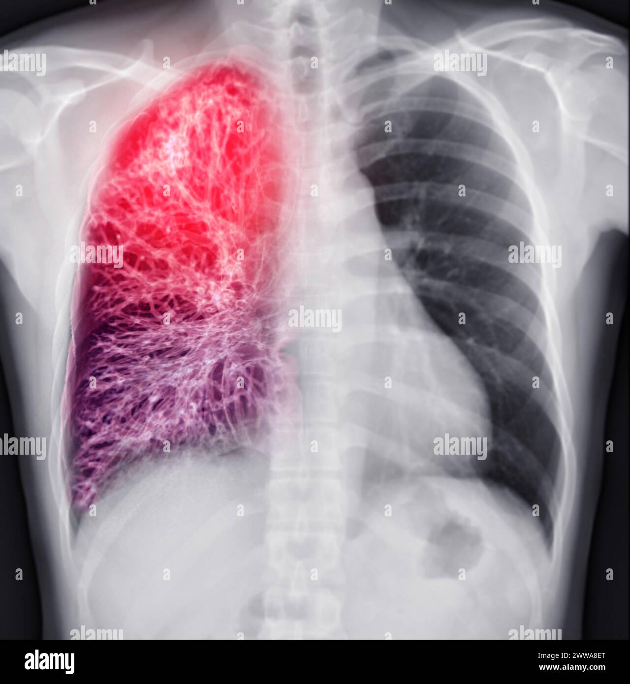Radiografia toracica della fusione toracica o polmonare umana con scansione TC 3D. Foto Stock