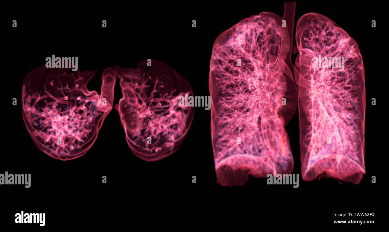 Una scansione TC toracica 3D che visualizza una lesione sul lobo superiore destro offre una visualizzazione dettagliata, facilitando l'identificazione precisa e i planni di trattamento Foto Stock