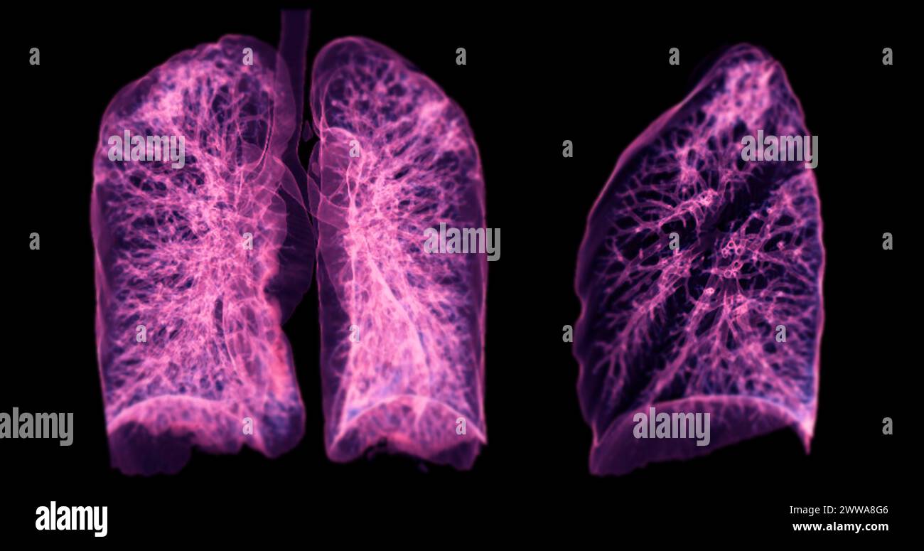 Una scansione TC toracica 3D che visualizza una lesione sul lobo superiore destro offre una visualizzazione dettagliata, facilitando l'identificazione precisa e i planni di trattamento Foto Stock