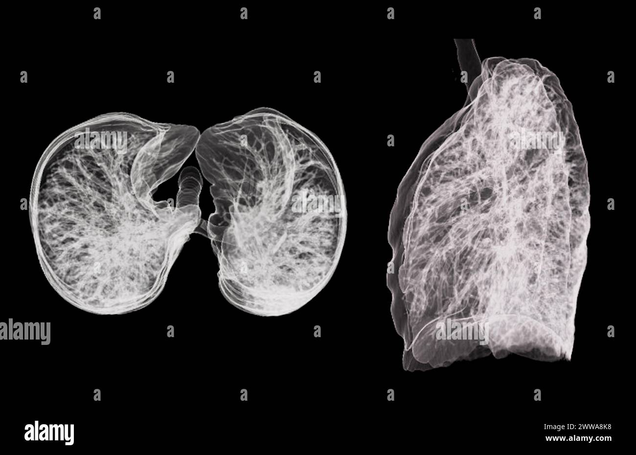 Una scansione TC toracica 3D che visualizza una lesione sul lobo superiore destro offre una visualizzazione dettagliata, facilitando l'identificazione precisa e i planni di trattamento Foto Stock