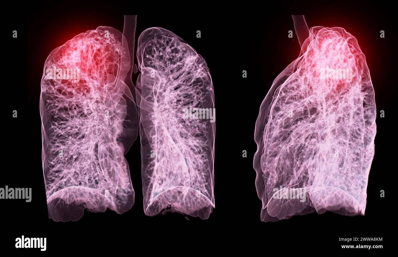 Una scansione TC toracica 3D che visualizza una lesione sul lobo superiore destro offre una visualizzazione dettagliata, facilitando l'identificazione precisa e i planni di trattamento Foto Stock