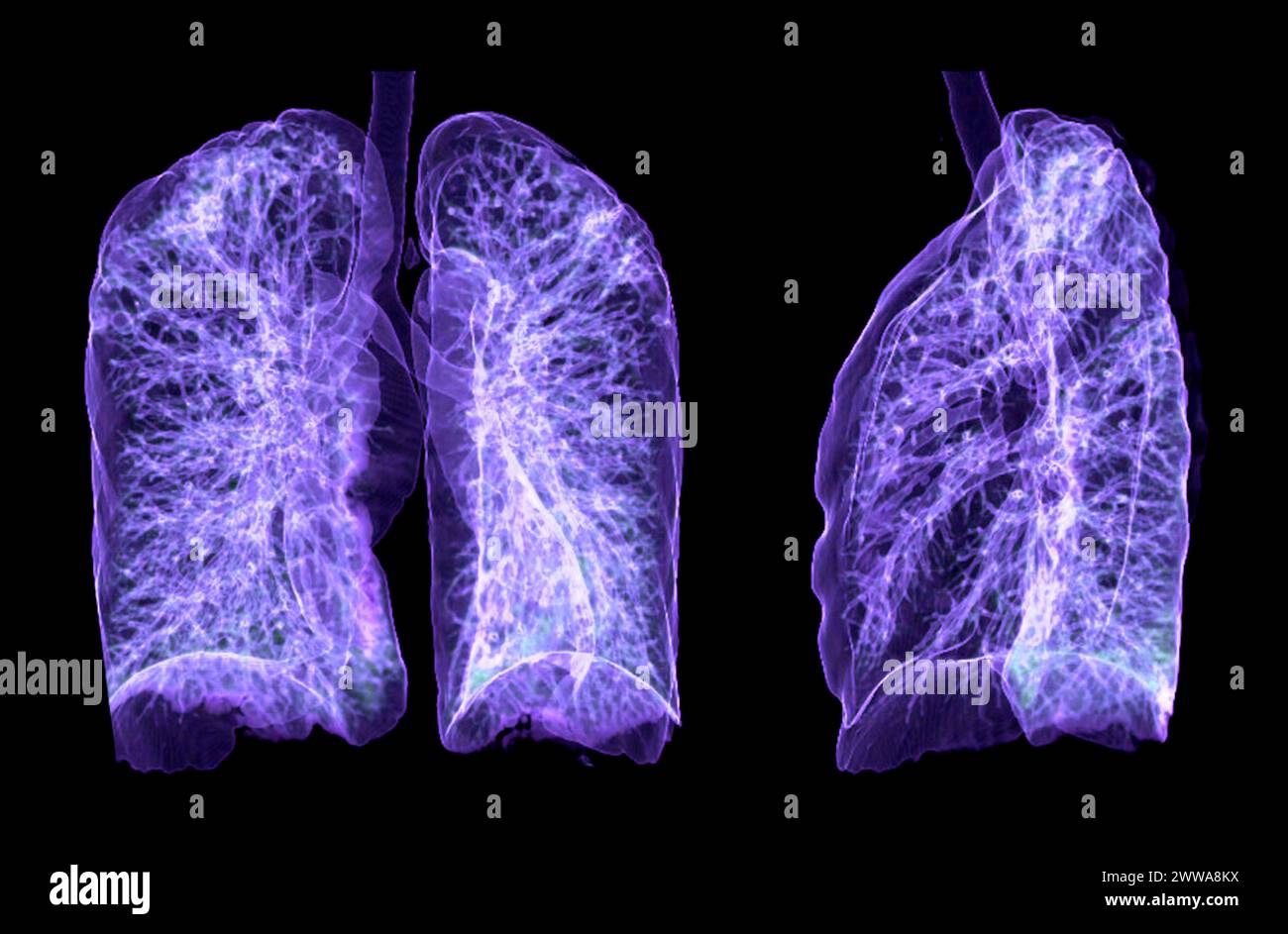 Immagine di rendering TC toracica o polmonare 3d che mostra trachea e polmoni nel sistema respiratorio. Foto Stock
