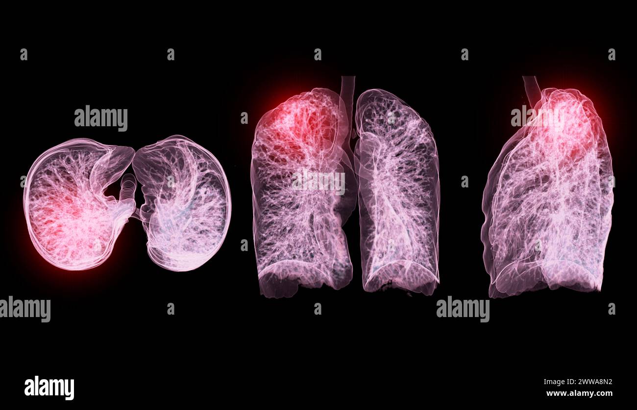 Una scansione TC toracica 3D che visualizza una lesione sul lobo superiore destro offre una visualizzazione dettagliata, facilitando l'identificazione precisa e i planni di trattamento Foto Stock