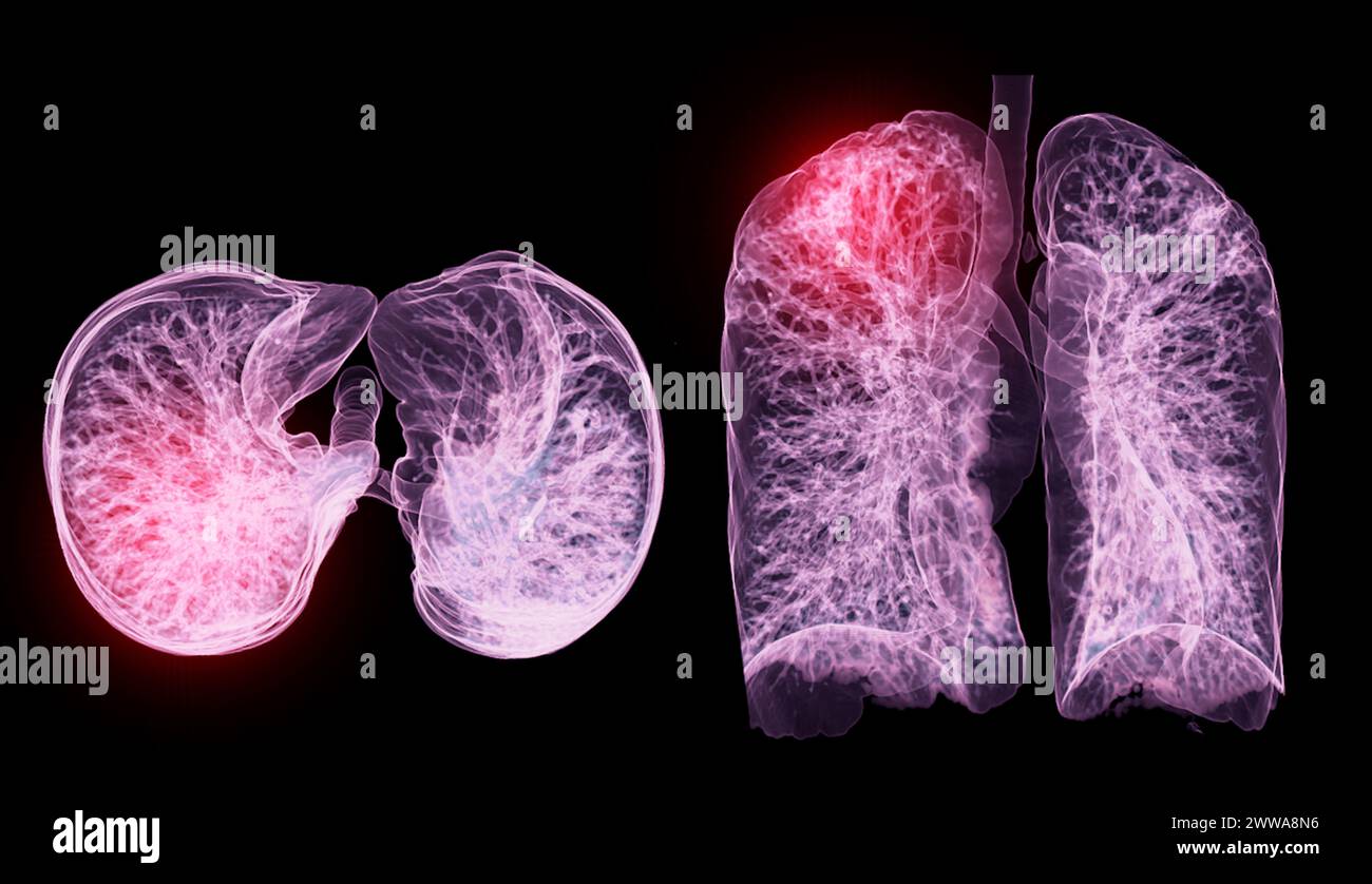 Una scansione TC toracica 3D che visualizza una lesione sul lobo superiore destro offre una visualizzazione dettagliata, facilitando l'identificazione precisa e i planni di trattamento Foto Stock