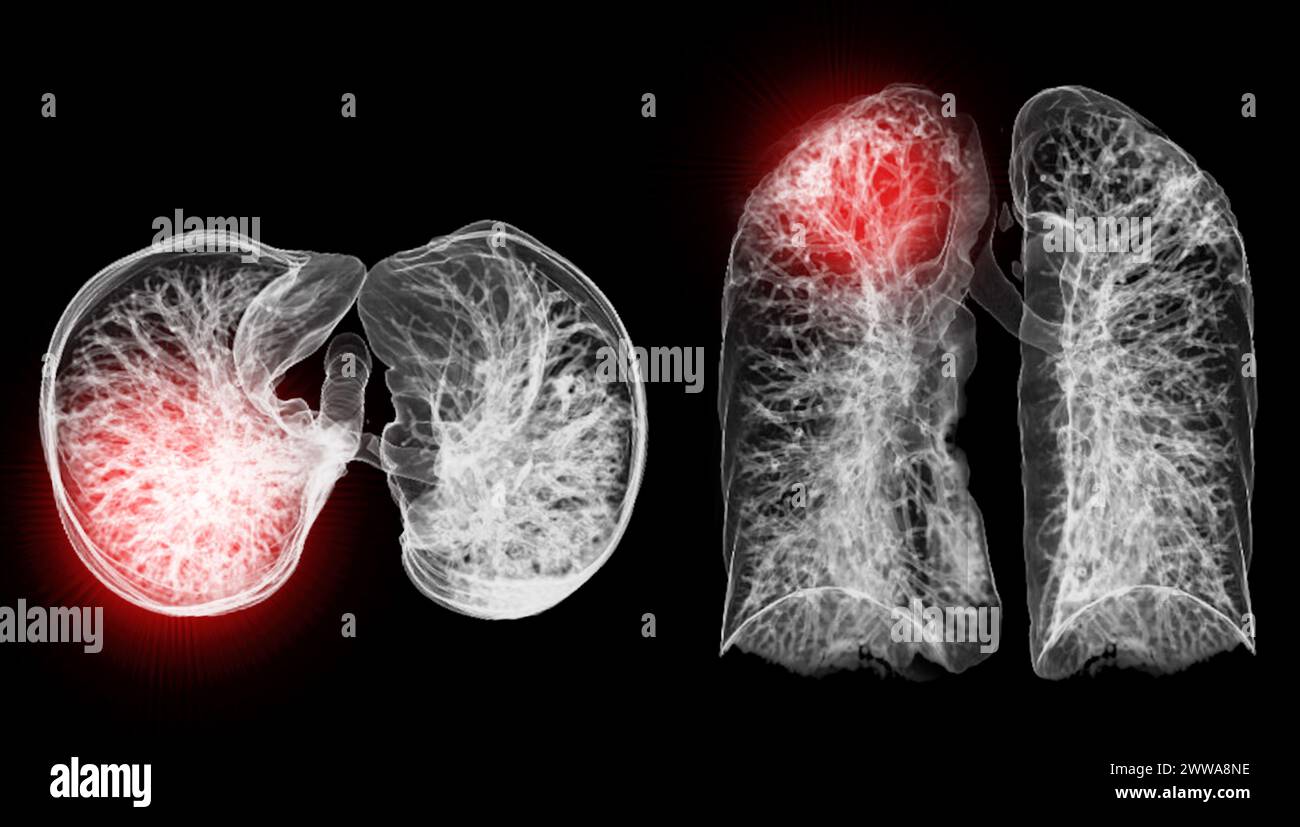 Una scansione TC toracica 3D che visualizza una lesione sul lobo superiore destro offre una visualizzazione dettagliata, facilitando l'identificazione precisa e i planni di trattamento Foto Stock