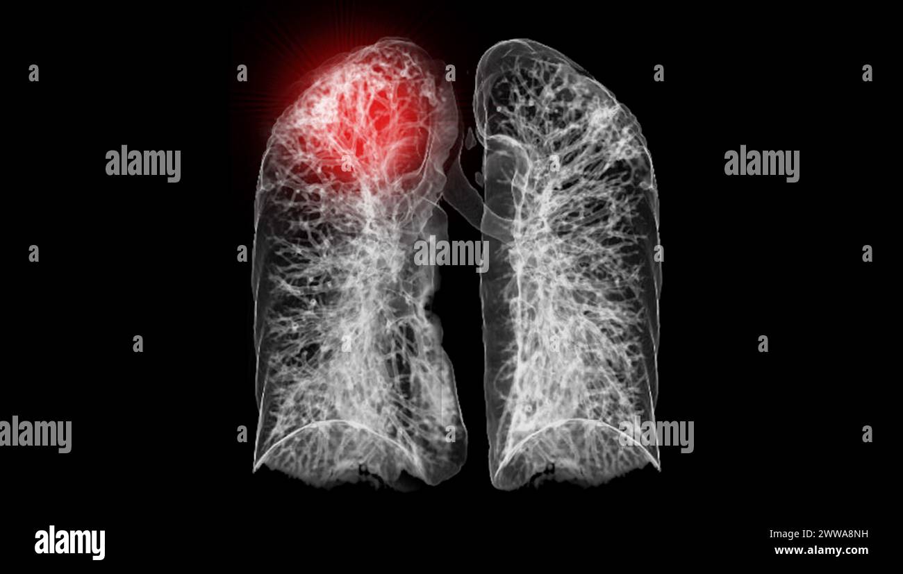 Una scansione TC toracica 3D che visualizza una lesione sul lobo superiore destro offre una visualizzazione dettagliata, facilitando l'identificazione precisa e i planni di trattamento Foto Stock