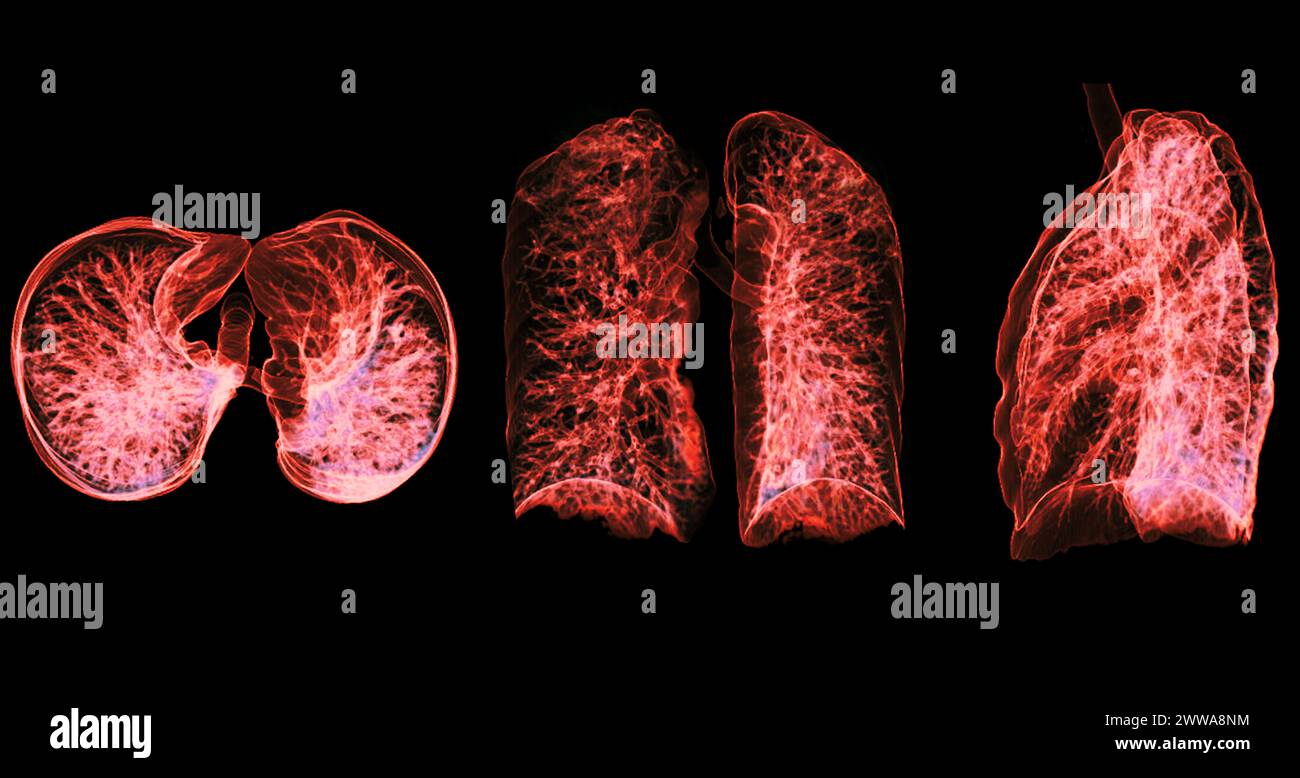 Immagine di rendering TC toracica o polmonare 3d che mostra trachea e polmoni nel sistema respiratorio. Foto Stock