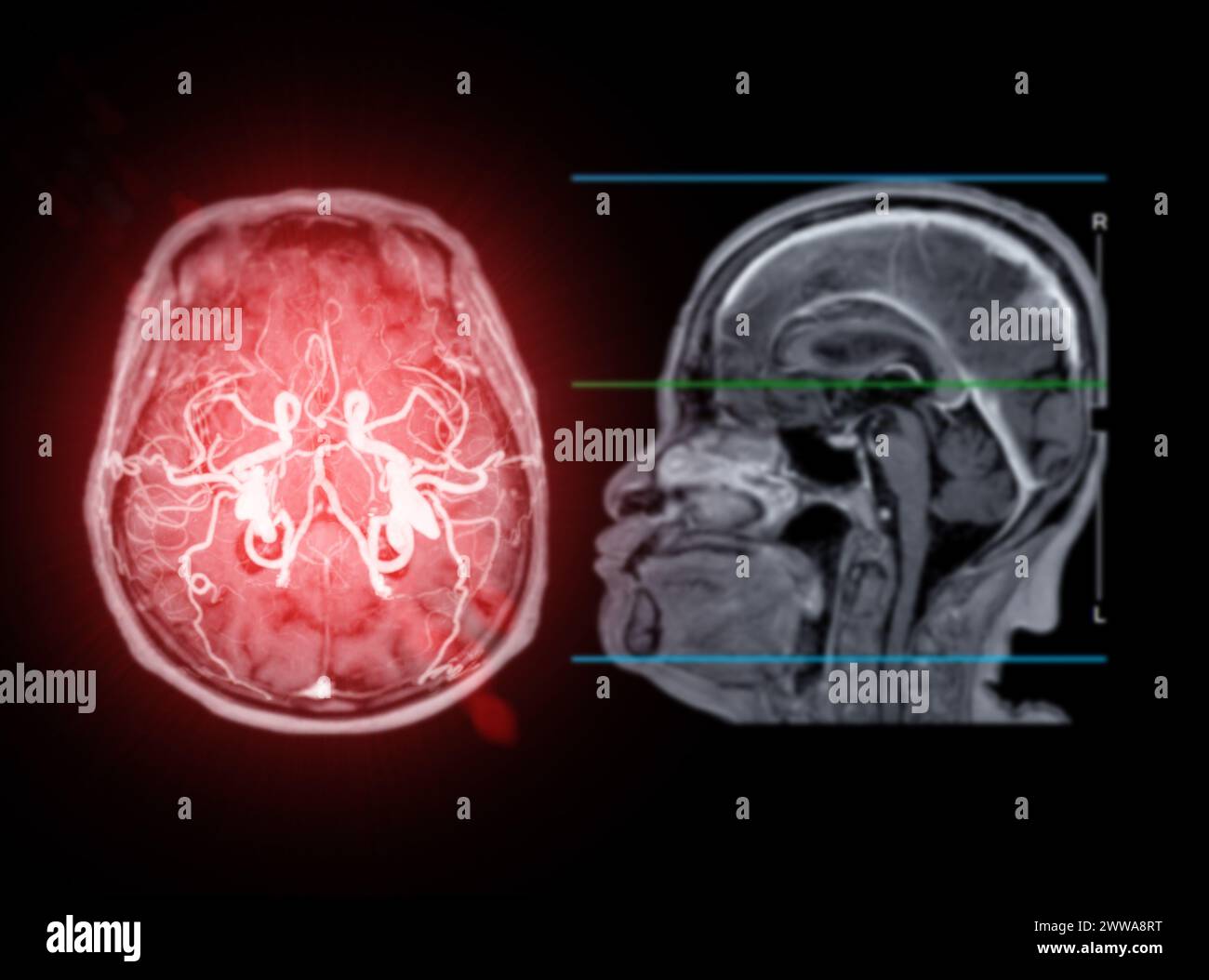 MRI cervello scansione piano sagittale per rilevare le malattie cerebrali sush come ictus malattia, tumori cerebrali e infezioni. Foto Stock