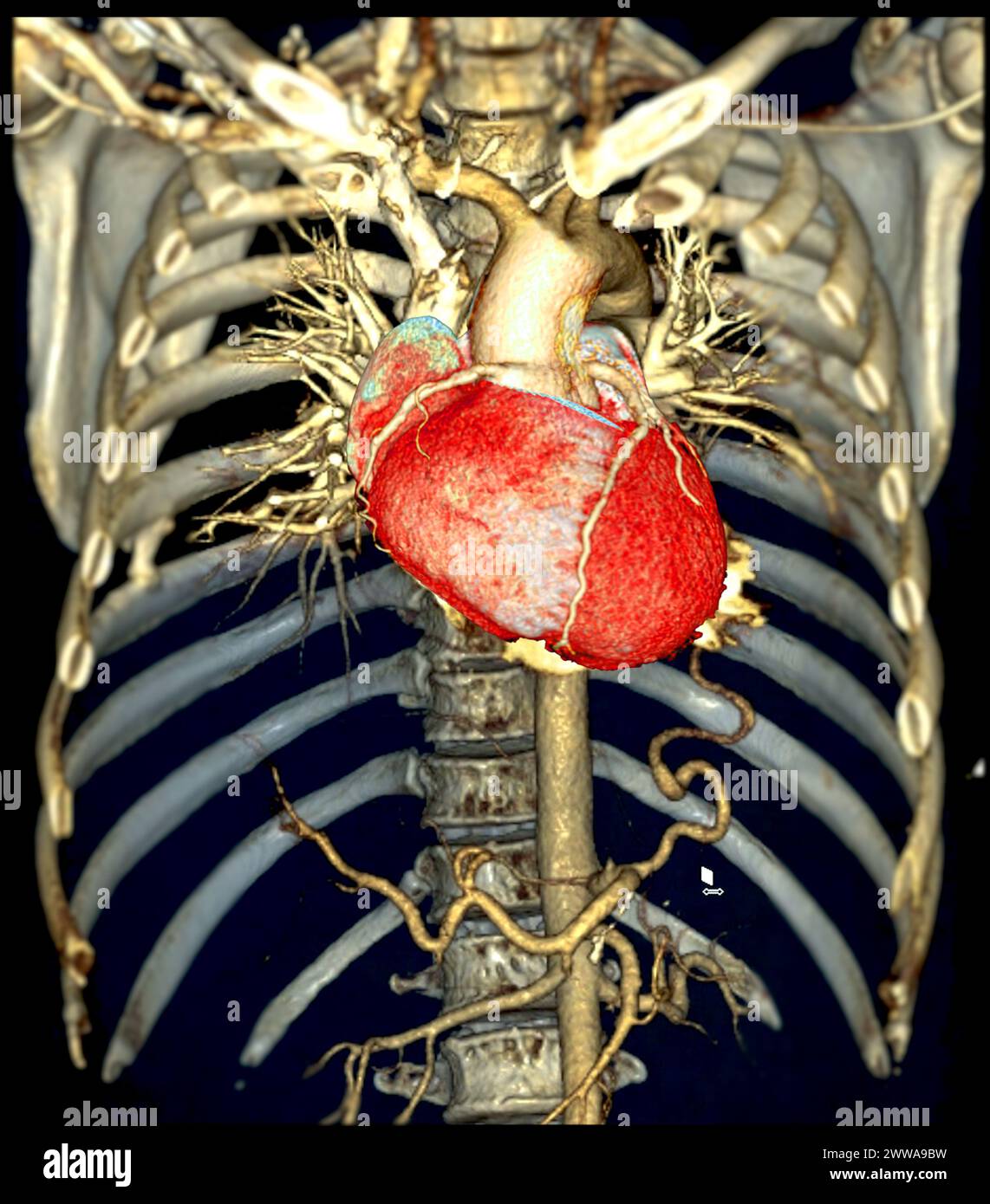 Il rendering 3D dell'aorta toracica CTA offre una visualizzazione dettagliata, fornendo informazioni chiare sull'anatomia aortica, sulla patologia e sulle strutture circostanti per Foto Stock