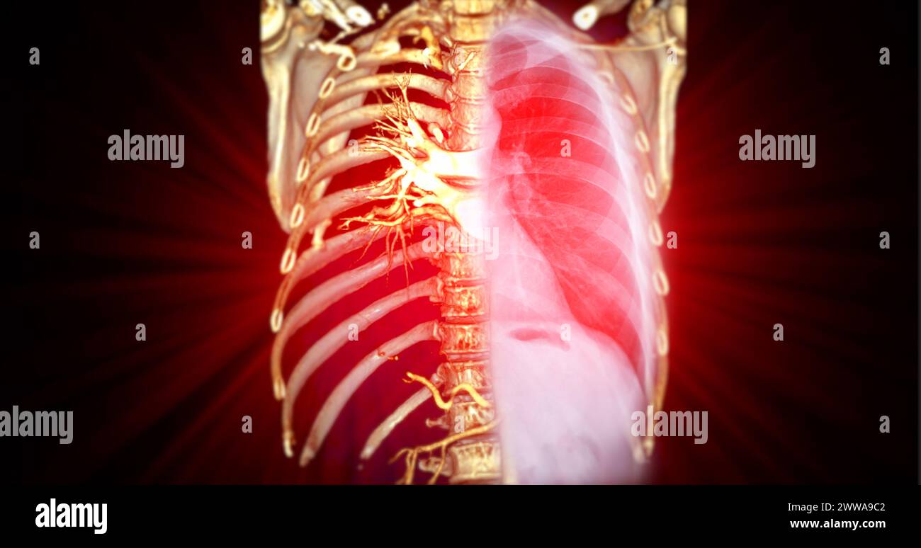 Il rendering 3D dell'aorta toracica CTA offre una visualizzazione dettagliata, fornendo informazioni chiare sull'anatomia aortica, sulla patologia e sulle strutture circostanti per Foto Stock