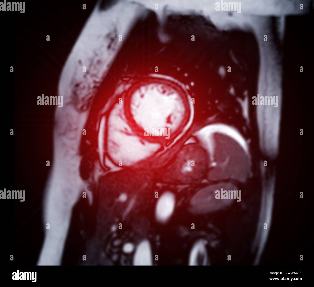 Le immagini RM cardiache sono fondamentali per valutare la salute cardiaca, identificare anomalie cardiache e guidare i piani di trattamento. Foto Stock