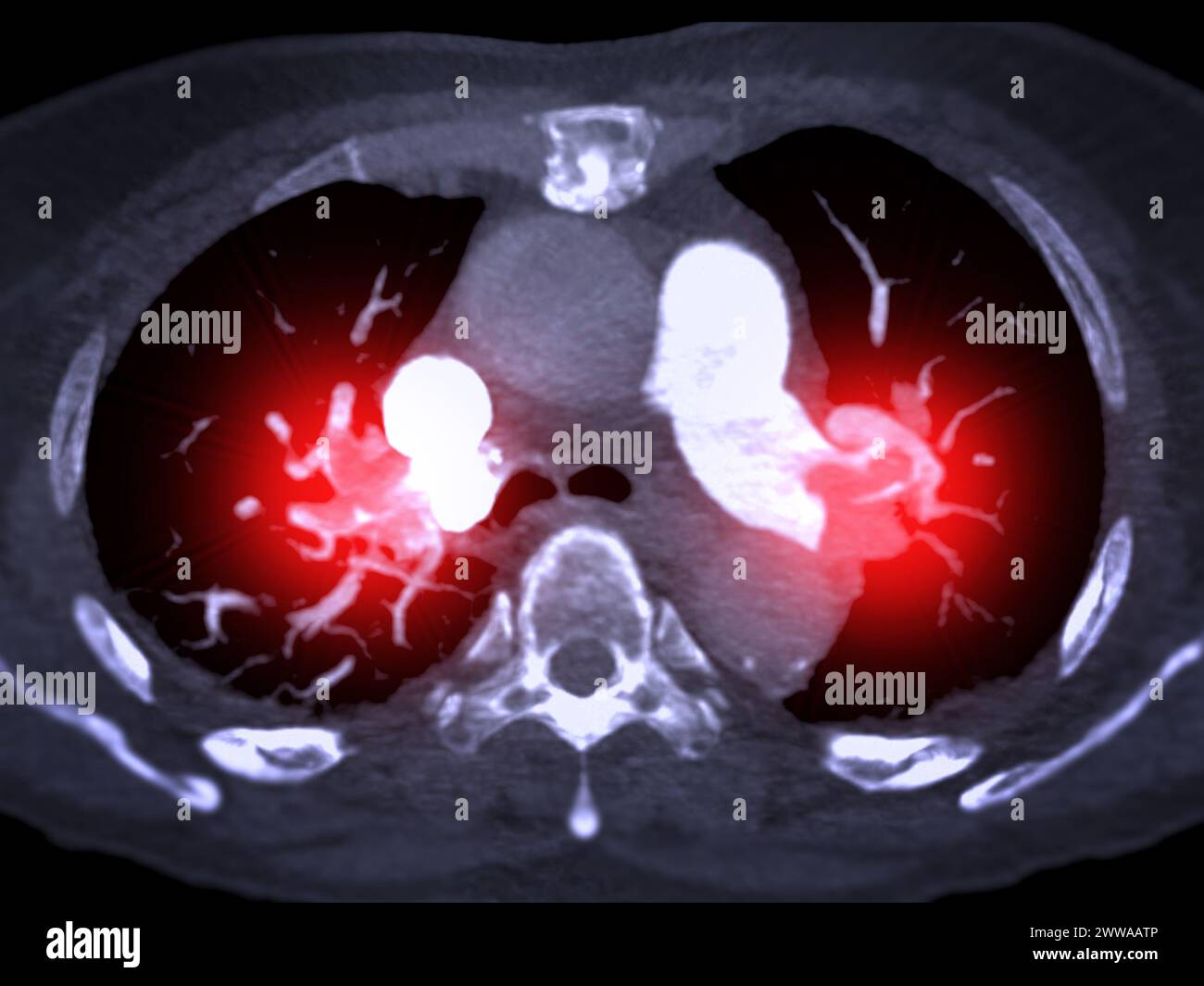 Un'arteria polmonare CTA rivela una vista dettagliata dei vasi sanguigni polmonari, catturando la presenza di embolia polmonare, una condizione in cui una cl ematica Foto Stock