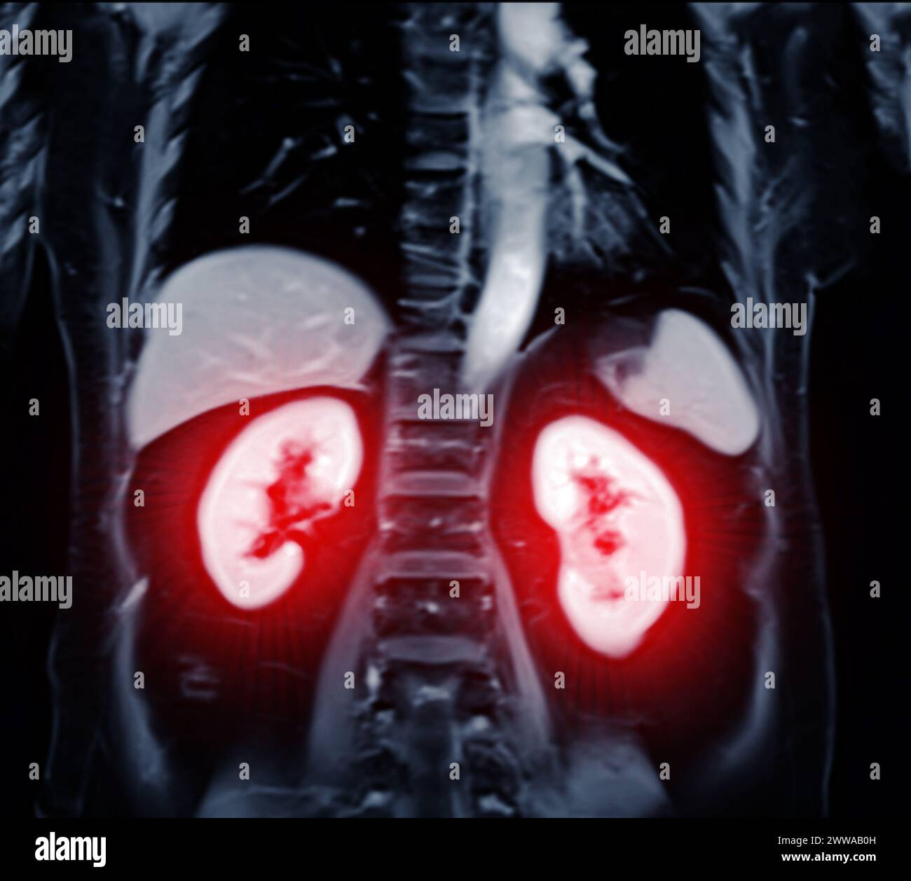 La risonanza magnetica della vista coronale dell'addome superiore è una tecnica di imaging non invasiva che fornisce immagini dettagliate di organi come fegato, pancreas e reni. Foto Stock