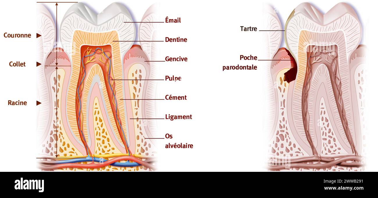 La tasca parodontale. Rappresentazione dell'anatomia del dente e di una patologia dentale, la tasca parodontale. Foto Stock