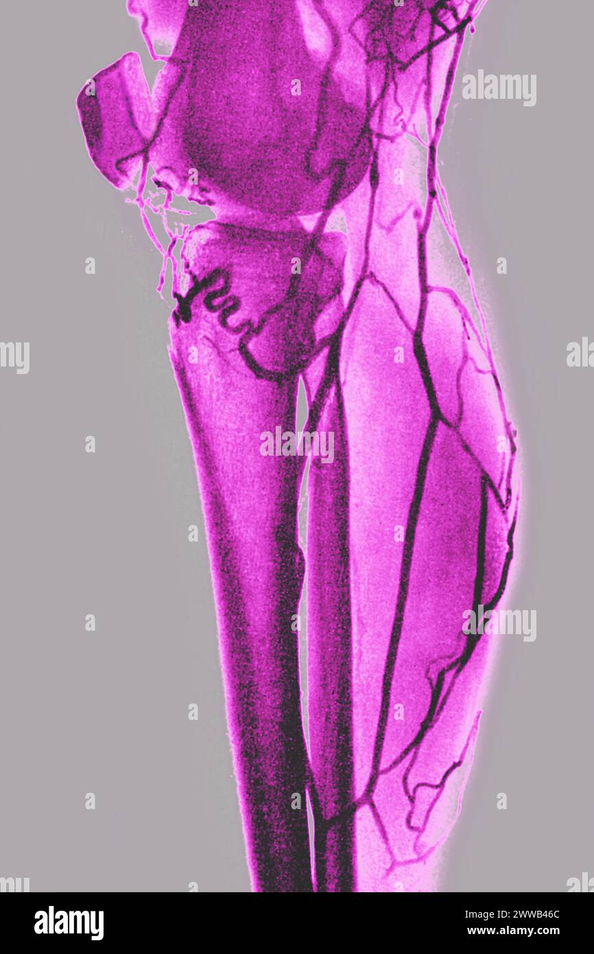 Arteriografia o angiografia (esame radiologico delle arterie di un arto inferiore visto nel profilo). Foto Stock