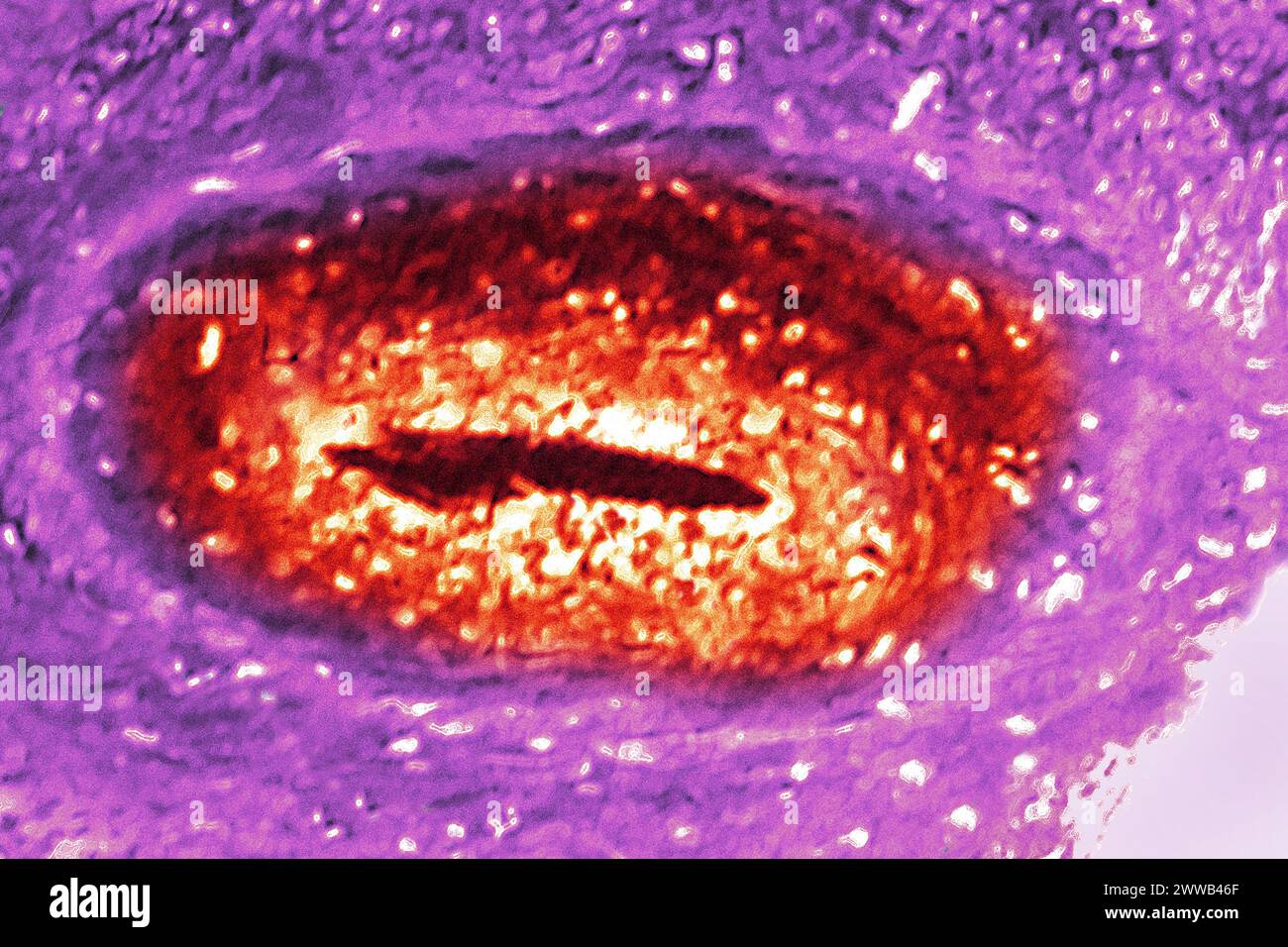 Arterite degli arti inferiori (malattia che colpisce le arterie delle gambe, è quasi sempre dovuto a un deposito di colesterolo nelle arterie. Foto Stock