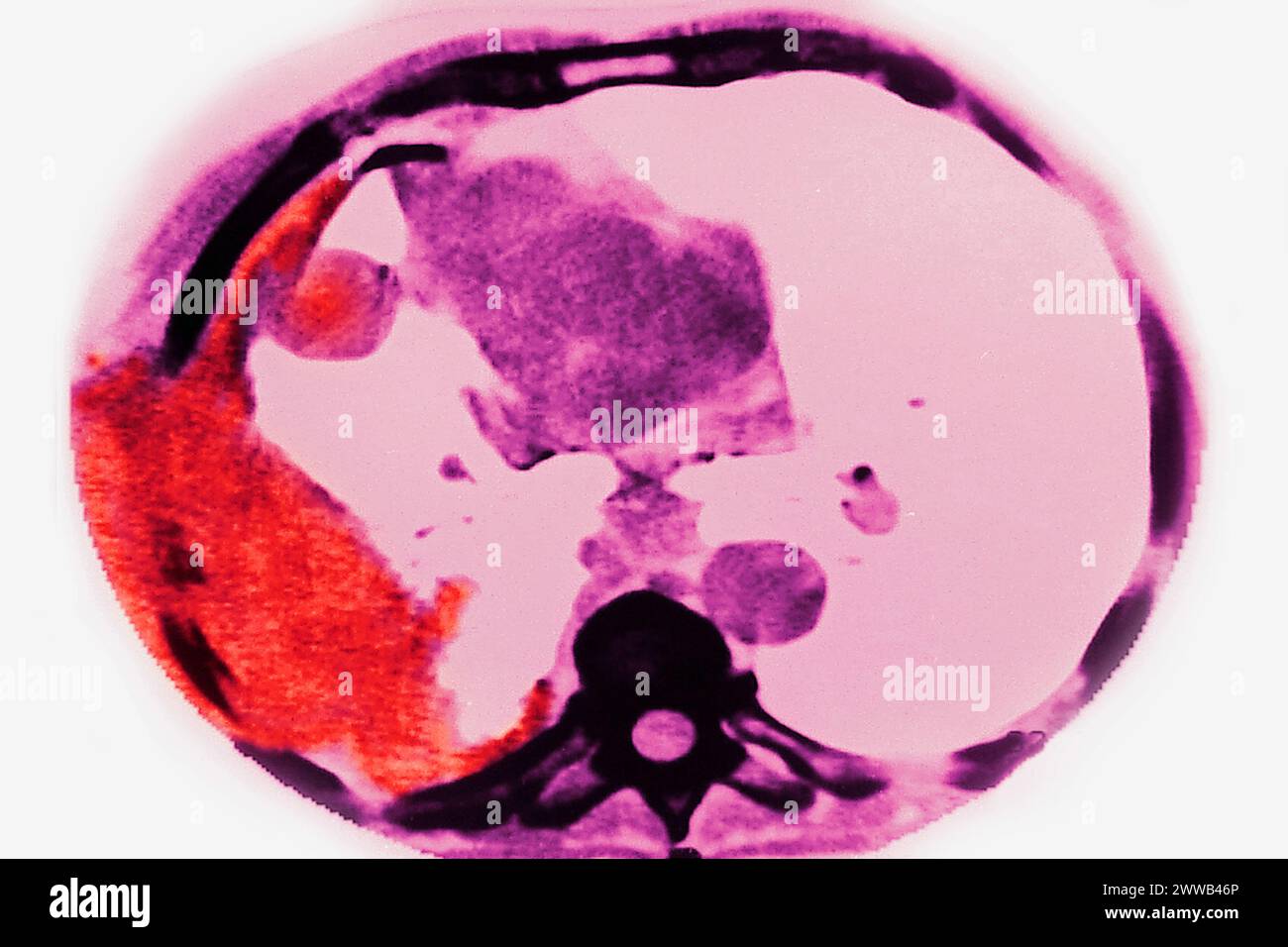 Cancro polmonare (tumore canceroso costituito da un gruppo di cellule cancerose che invadono i tessuti vicini e li distruggono, possono anche diffondersi in metastasi). Foto Stock