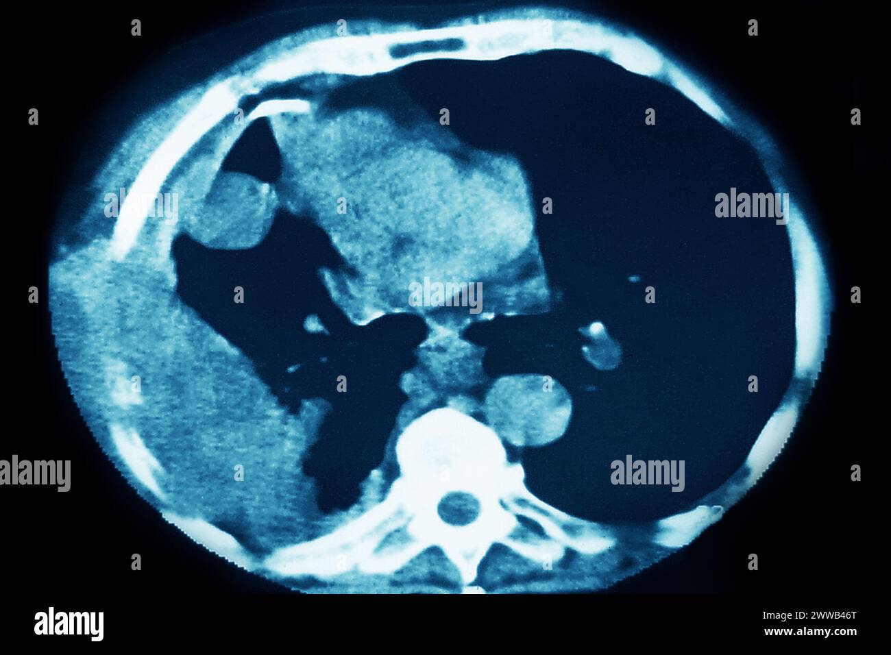 Cancro polmonare (tumore canceroso costituito da un gruppo di cellule cancerose che invadono i tessuti vicini e li distruggono, possono anche diffondersi in metastasi). Foto Stock