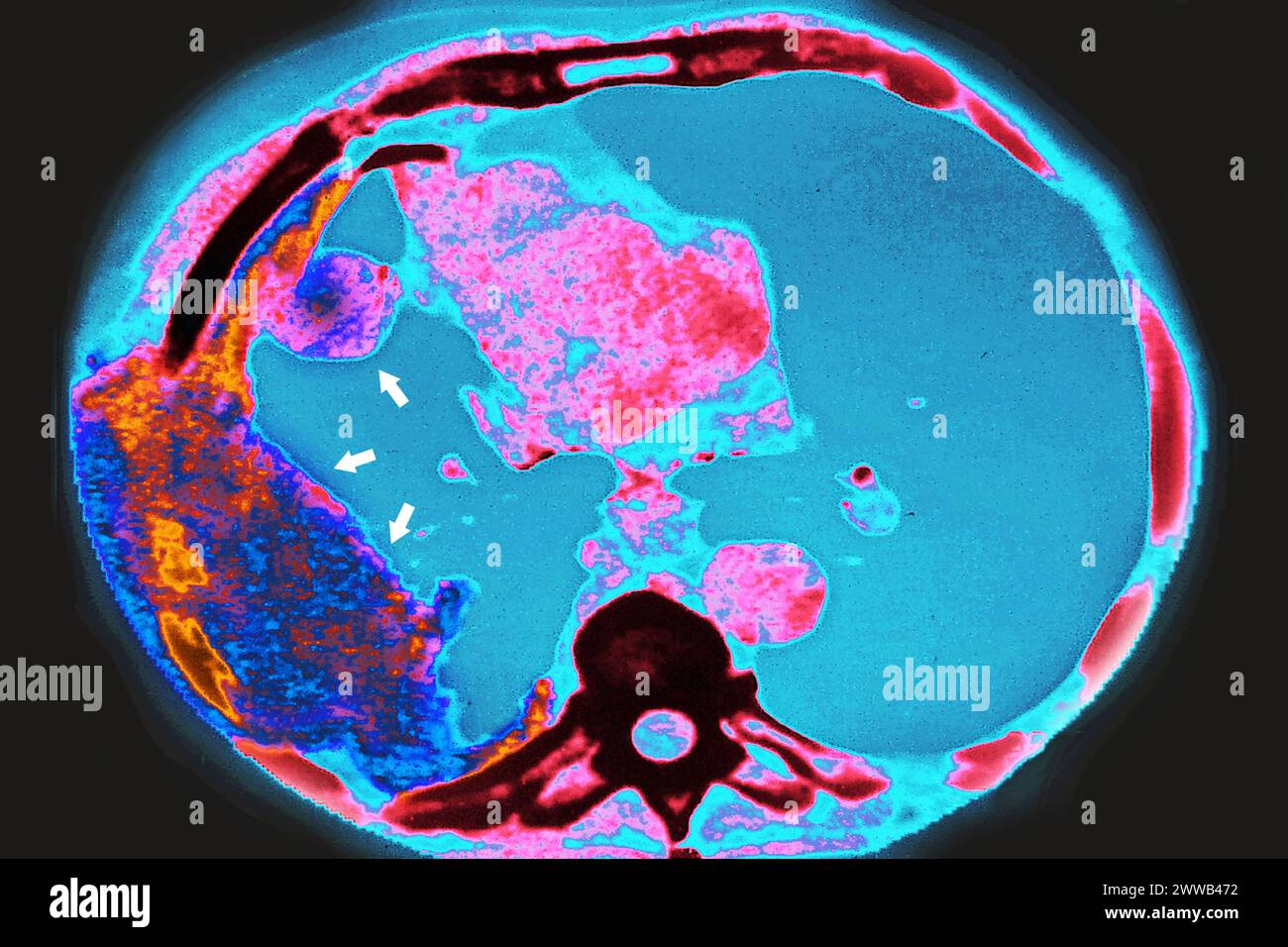 Cancro polmonare (tumore canceroso costituito da un gruppo di cellule cancerose che invadono i tessuti vicini e li distruggono, possono anche diffondersi in metastasi). Foto Stock