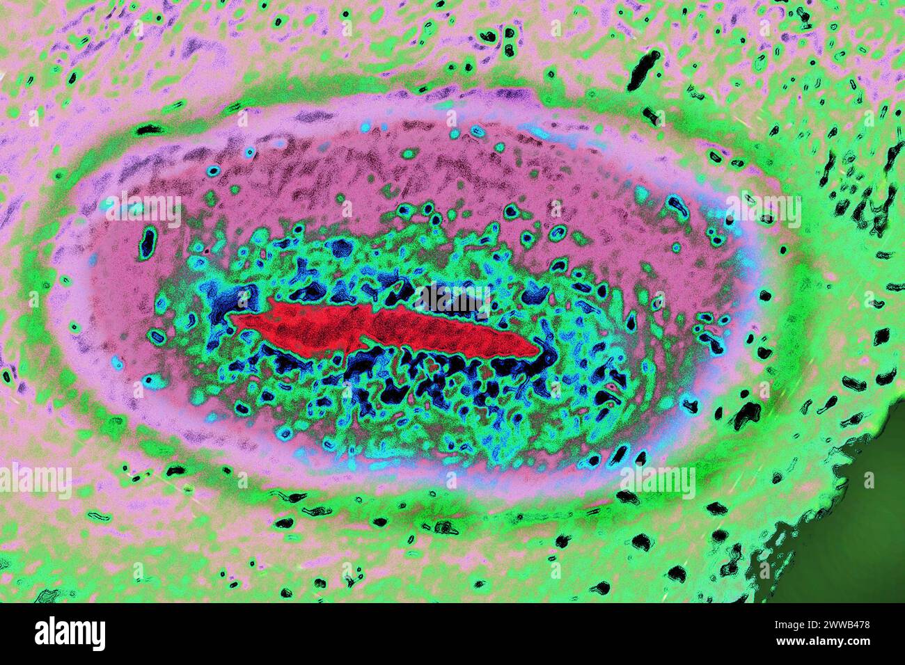 Arterite degli arti inferiori (malattia che colpisce le arterie delle gambe, è quasi sempre dovuto a un deposito di colesterolo nelle arterie. Foto Stock