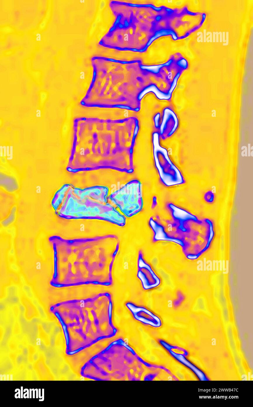 Frattura vertebrale spontanea dovuta a oteoporosi (malattia ossea caratterizzata da una diminuzione della massa ossea. Foto Stock