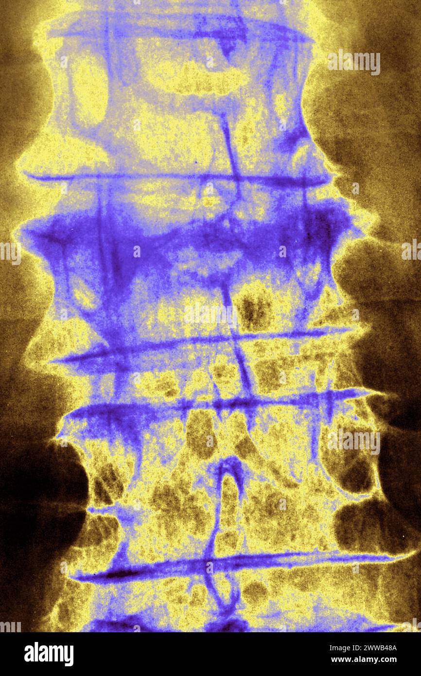 Osteoporosi vertebrale (malattia ossea caratterizzata da una diminuzione della massa ossea. Foto Stock