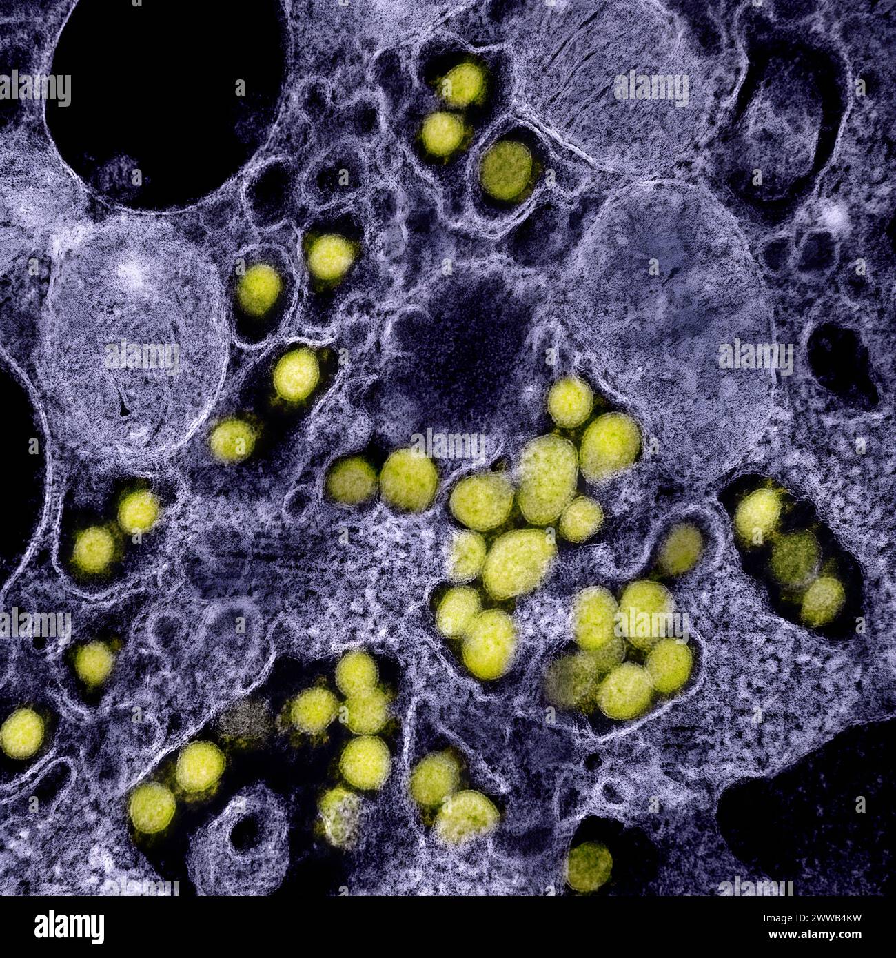 Micrografia elettronica di trasmissione di particelle virali SARS-CoV-2, isolate da un paziente. Foto Stock