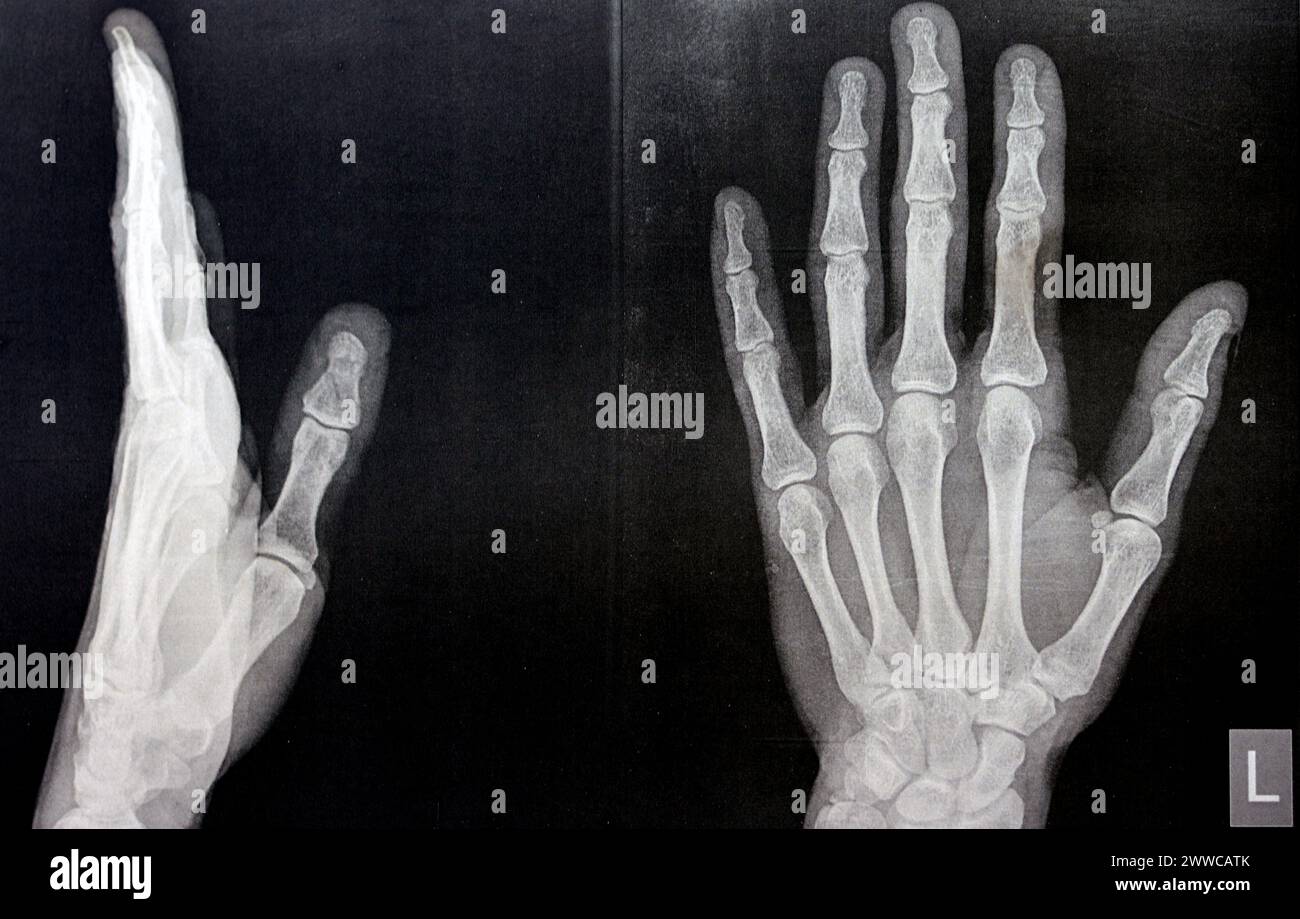 Radiografia semplice della mano sinistra di un maschio adulto dopo un trauma diretto al dito del pollice sinistro che mostra un normale studio osseo, radiografia normale della mano ad ex Foto Stock