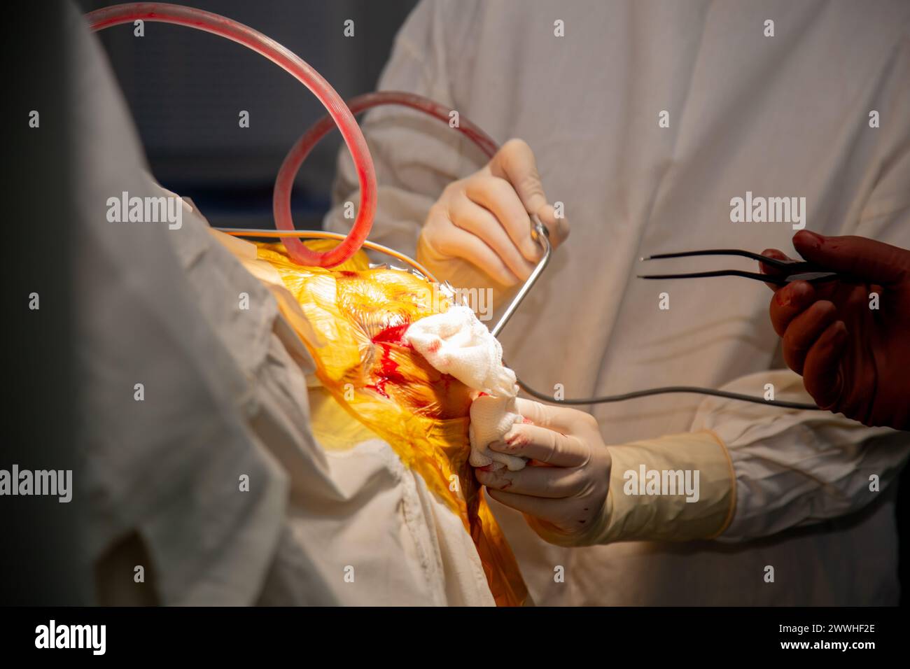 I chirurghi eseguono un'operazione. Foto reali dell'operazione. Una vera sala operatoria. Foto di alta qualità Foto Stock