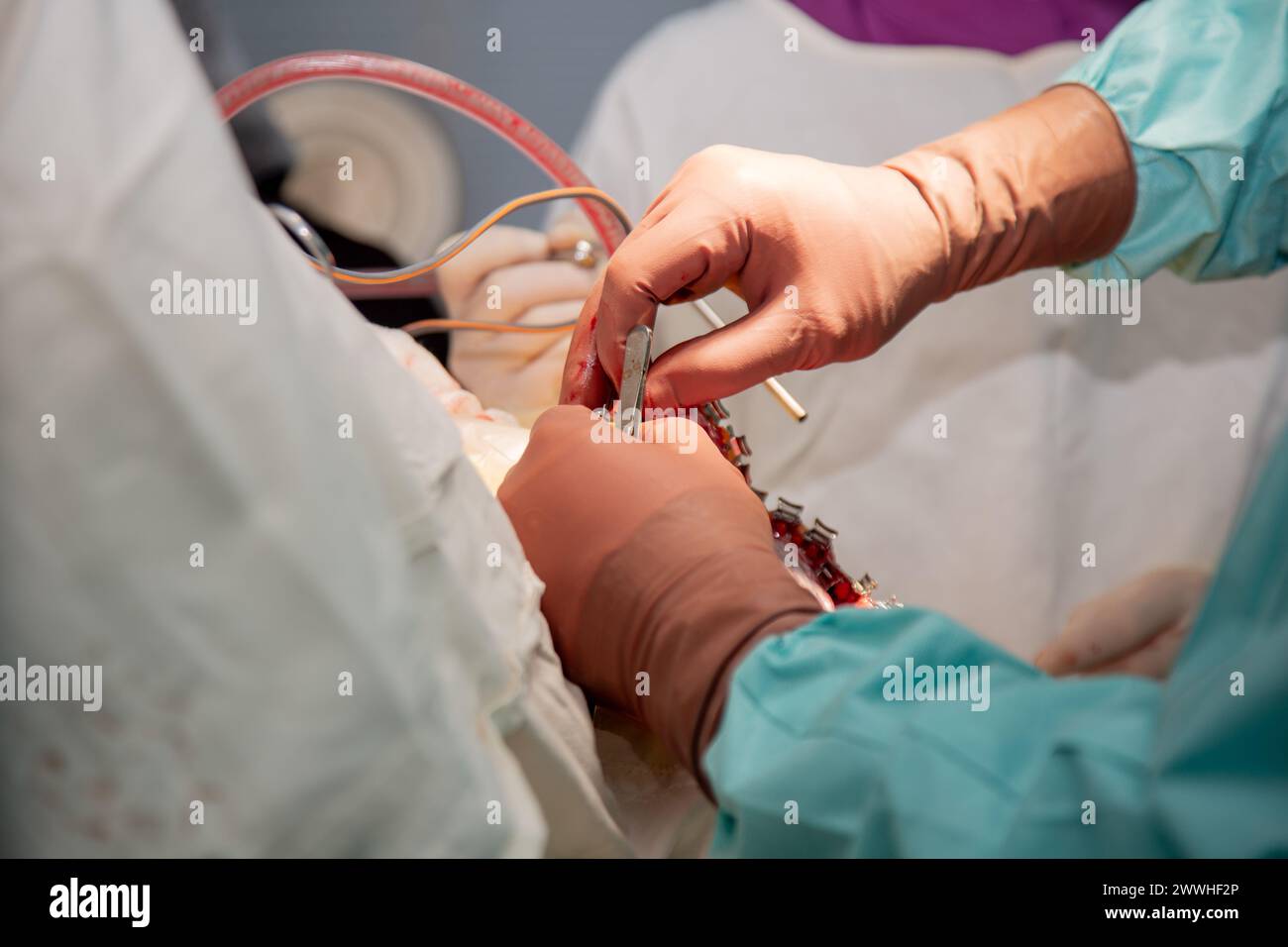 I chirurghi eseguono un'operazione. Foto reali dell'operazione. Foto Stock