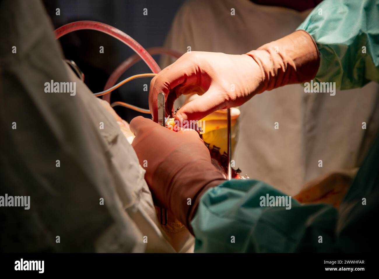 I chirurghi eseguono un'operazione. Foto reali dell'operazione. Foto Stock