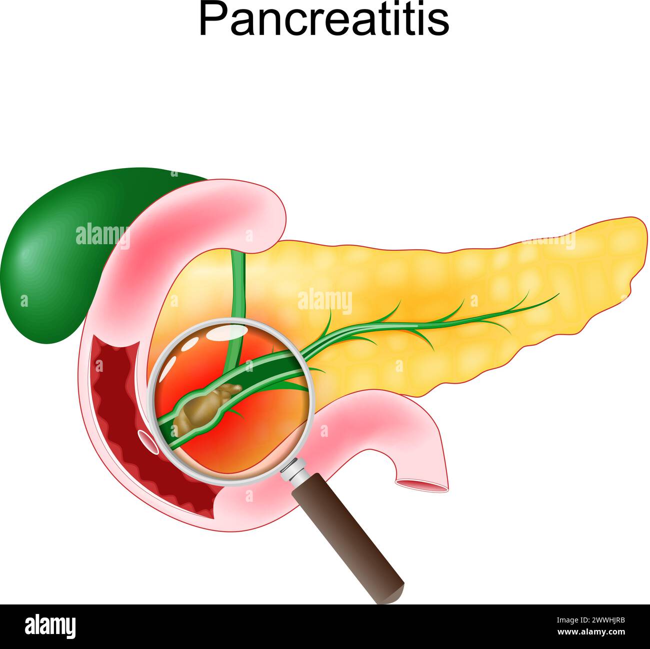 Pancreatite acuta. Primo piano di un pancreas realistico, duodeno e cistifellea. Sezione trasversale di un dotto pancreatico con calcoli biliari vista tramite un magnete Illustrazione Vettoriale