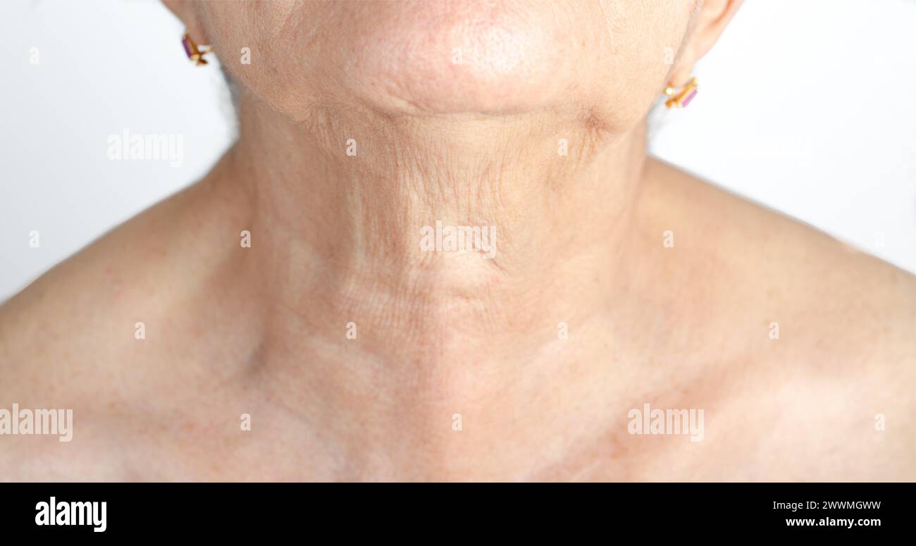 Cicatrice sul collo da intervento chirurgico di rimozione della tiroide in una donna adulta anziana. Foto Stock