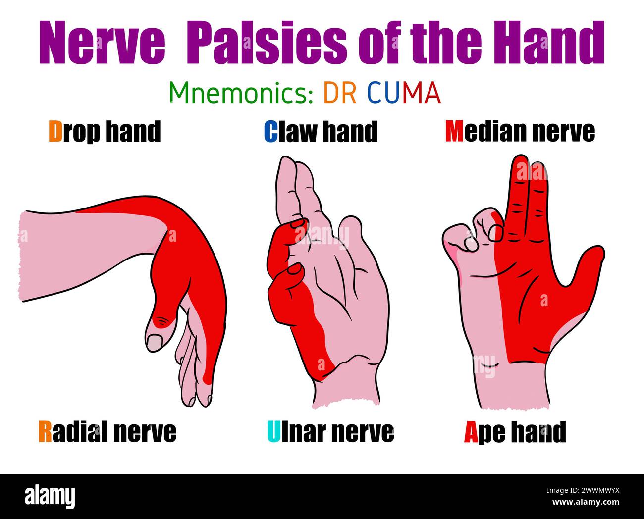 Paralisi nervosa della mano. Illustrazione per studenti e medici Foto Stock