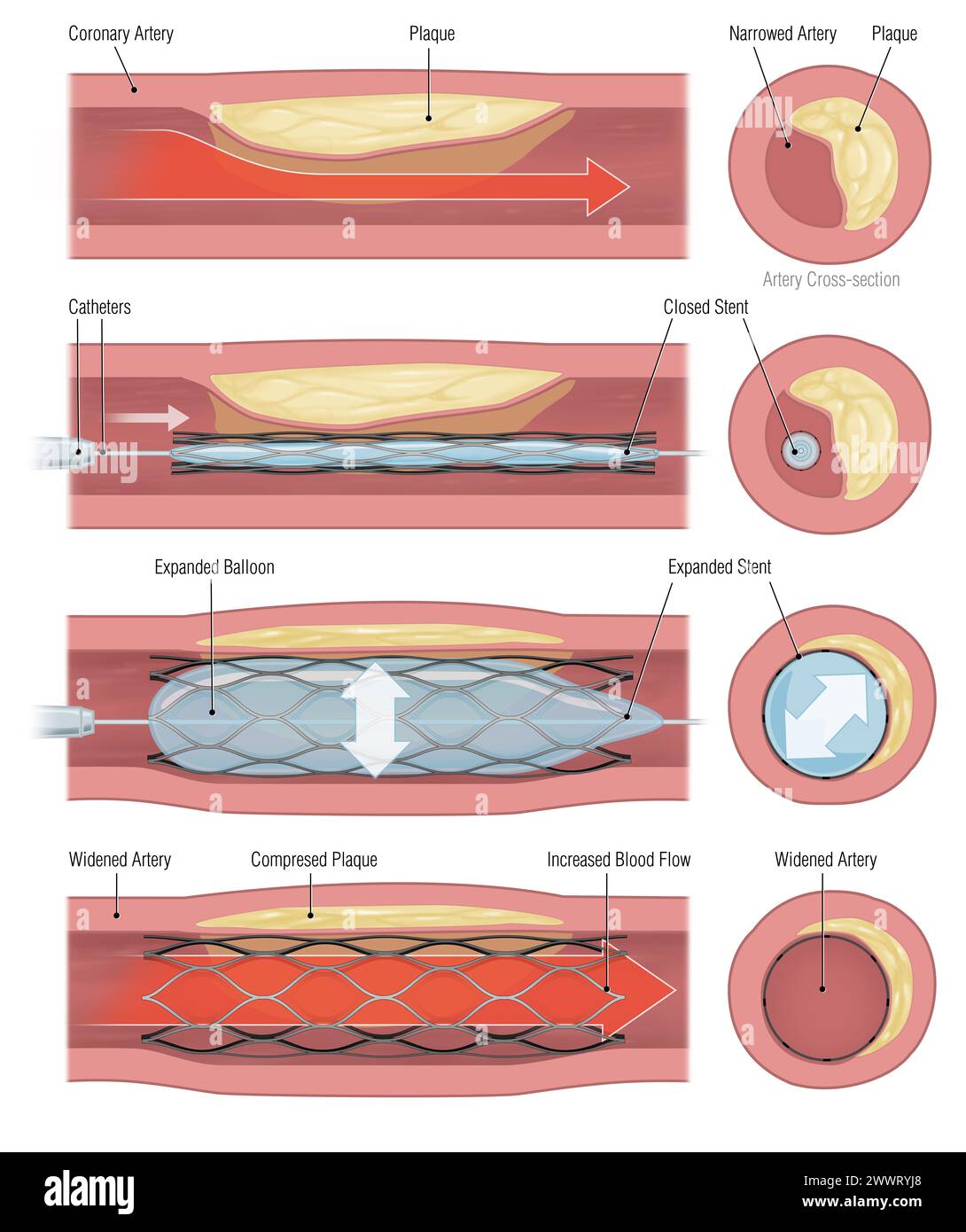 impianto di stent per sostenere la circolazione sanguigna nei vasi sanguigni Foto Stock