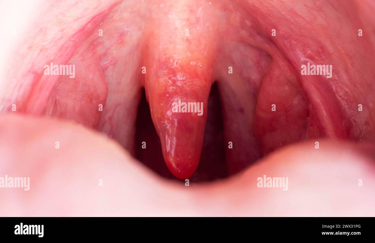 Infiammazione dell'uvula nella cavità orale a causa di infezione e virus. Il trattamento della malattia è l'uvulite. Gola rossa a causa di malattia, macro Foto Stock