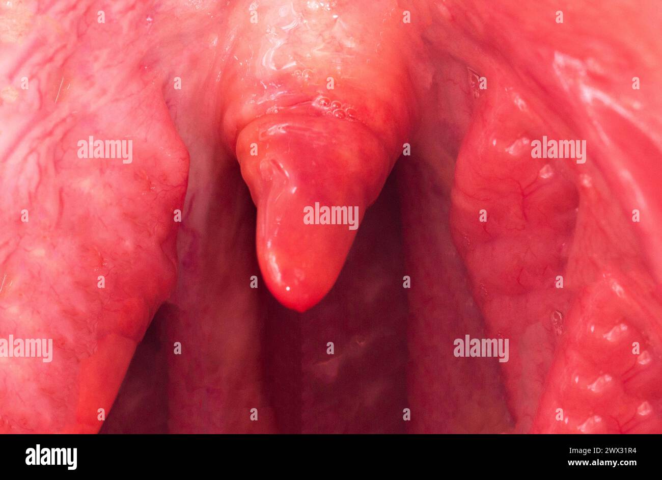 Uvulite e mal di gola nella cavità orale a causa di malattia. Infiammazione dell'uvula e tonsille a causa di infezioni durante la malattia, primo piano Foto Stock