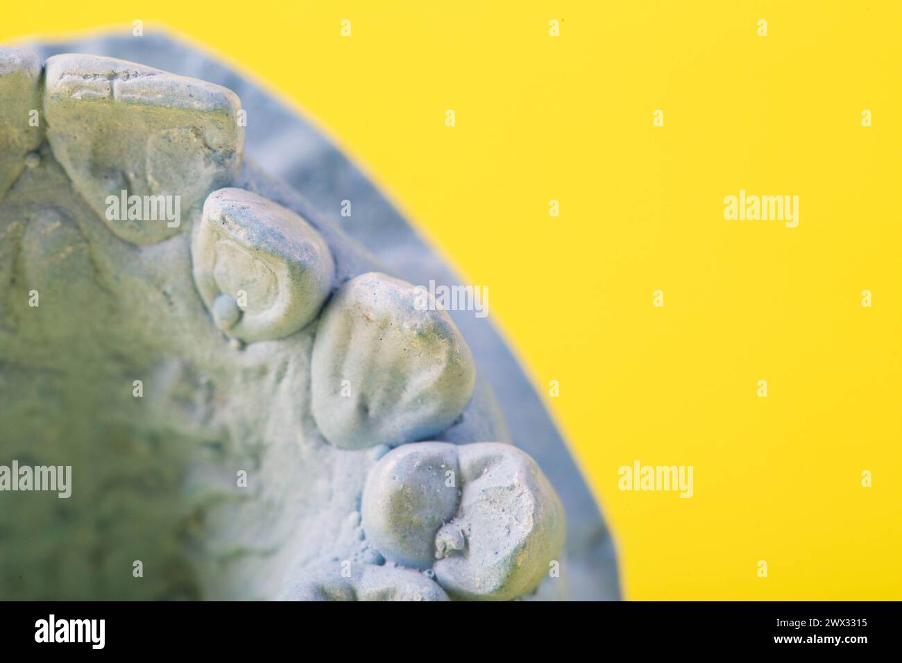 Intonaco blu impressione della mascella dentale di un paziente con denti storti e malocclusioni su sfondo giallo. Produzione di controventature per correggere il morso Foto Stock