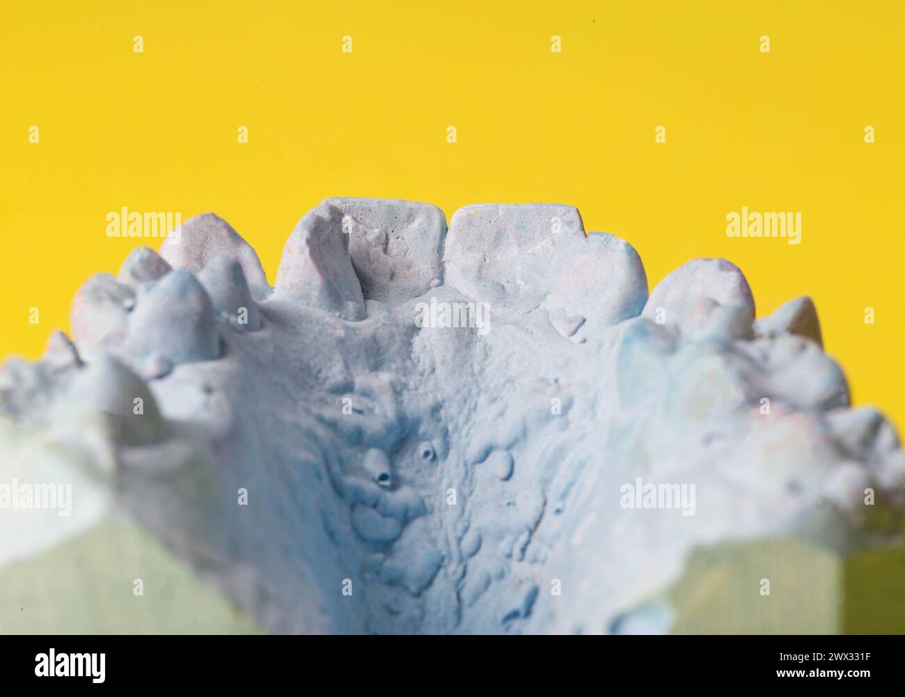 Intonaco blu impressione della mascella dentale di un paziente con denti storti e malocclusioni su sfondo giallo. Produzione di controventature per correggere il morso Foto Stock