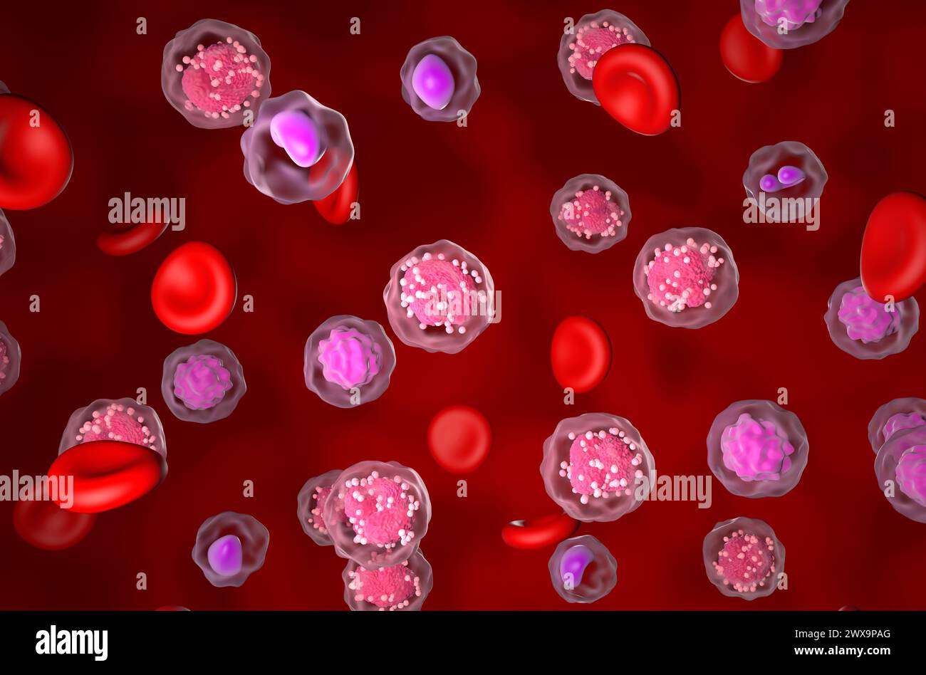 Leucemia linfocitica acuta (TUTTE) - Vista isometrica illustrazione 3d. Foto Stock