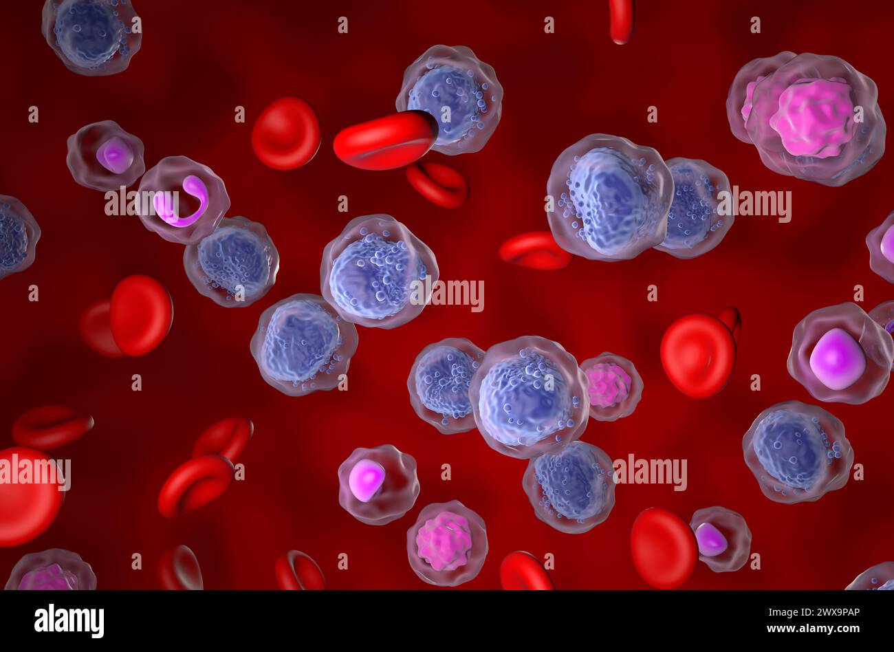 Leucemia mieloide acuta (AML) - Vista isometrica illustrazione 3d. Foto Stock