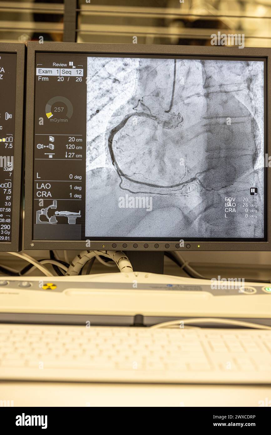 Sequenza angiografica che funziona in senso orario utilizzando raggi X con un mezzo di contrasto iniettato da un tubo inserito nelle arterie (sinistra e centro), per mostrare la h Foto Stock