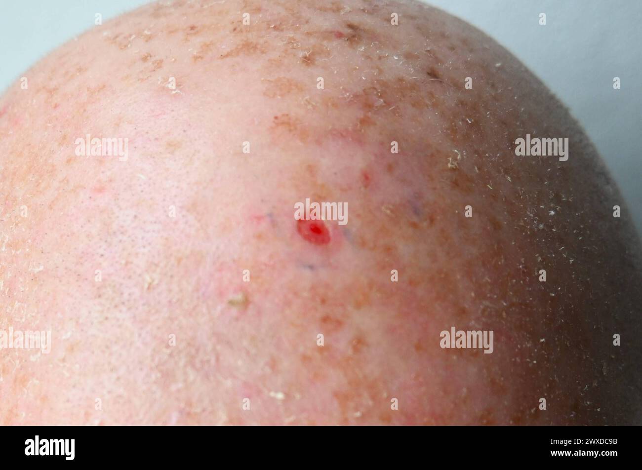 Vorbeugung, Weisser Hautkrebs. Nach der laser-Behandlung beim Hautarzt bzw der Dermatologie: Die aktinische Keratose, auch aktinische Präkanzerose oder solare Keratose oder Licht-Keratose - durch Strahlung hervorgerufen - ist eine lichtbedingte Hautveränderung. Es handelt sich um eine durch langjährige intensive Einwirkung von Sonnenlicht - Sprich UV-Strahlung - verursachte chronische Schädigung der verhornten Oberhaut, typischerweise mit rötlichen, fest haftenden Schuppen auf der Haut. Die Hautschädigung schreitet nur langsam fort, kann aber nach Jahren in eine form des Hautkrebses übergehen. Foto Stock