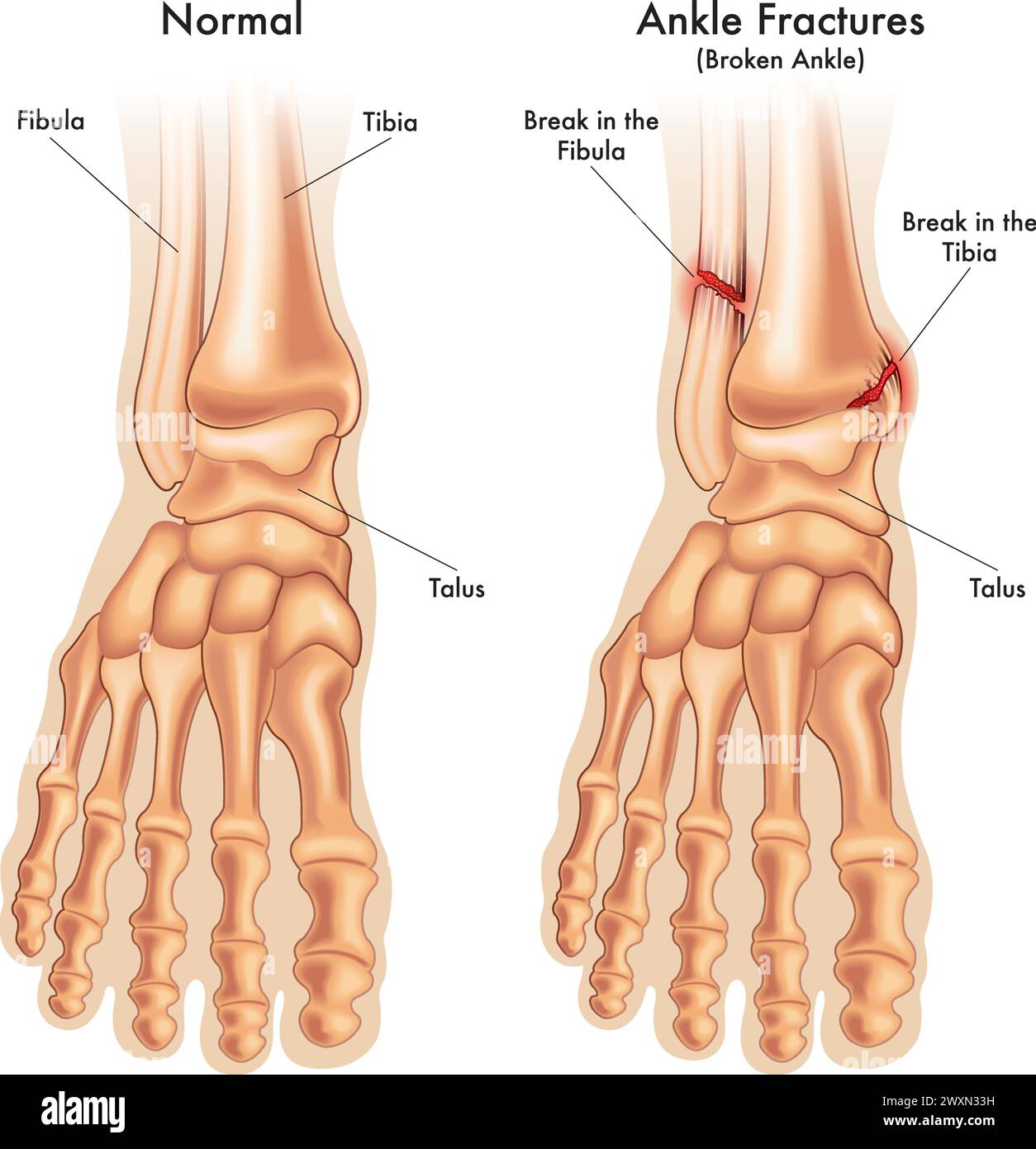l'illustrazione medica mette a confronto una caviglia normale del piede, con una caviglia del piede fratturata in due punti, con annotazioni. Illustrazione Vettoriale